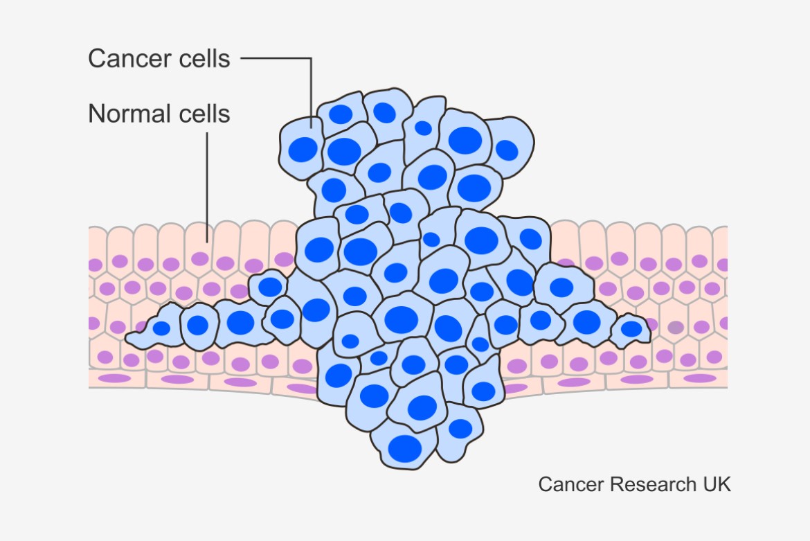 Level 4 Cancer Definition | Quels sont les stades d’un cancer – BPJU